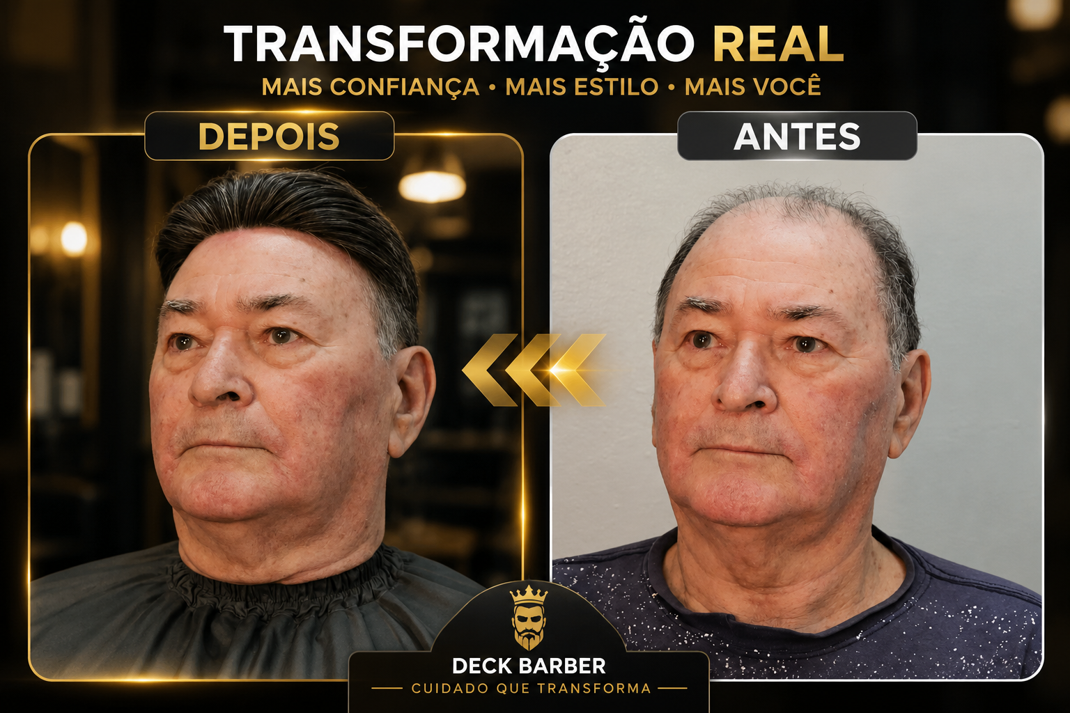 Prótese capilar